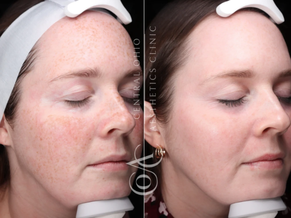 Side-by-side comparison of a woman's face before and after a skin treatment. Left shows freckles and redness; right shows smoother, clearer skin. Side-by-side comparison of a woman's face before and after a skin treatment. Left shows freckles and redness; right shows smoother, clearer skin.