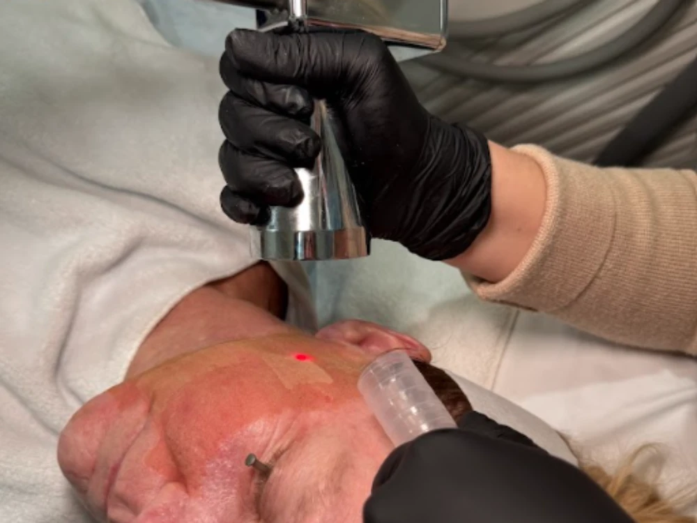 Person receiving laser skin treatment; face partially covered with a cloth, laser device held by a gloved hand emits red light, creating a focused atmosphere. Person receiving laser skin treatment; face partially covered with a cloth, laser device held by a gloved hand emits red light, creating a focused atmosphere.