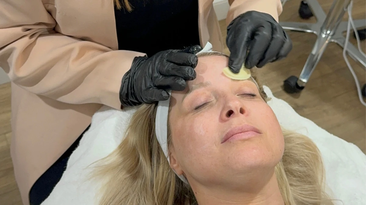 How Many Chemical Peels Are Usually Needed? How Many Chemical Peels Are Usually Needed?