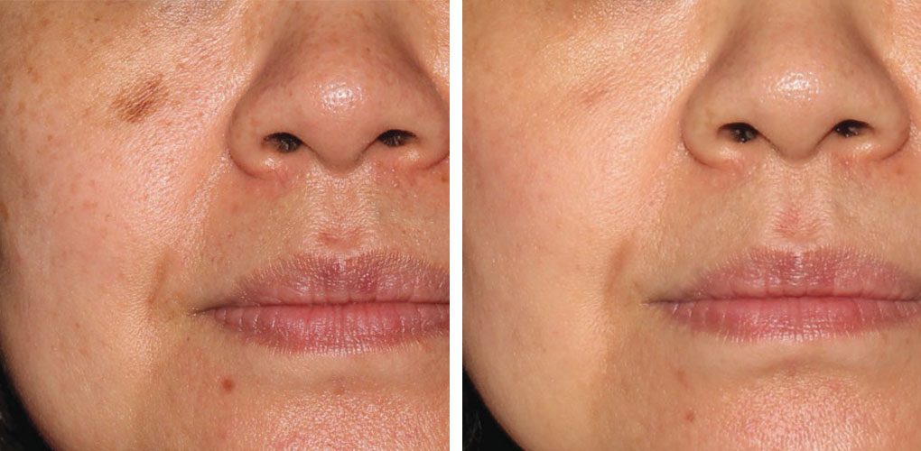 Close-up of a woman's face showing skin pigmentation differences. Left image: visible brown spot on cheek. Right image: cleared complexion. Before-and-after skincare treatment.