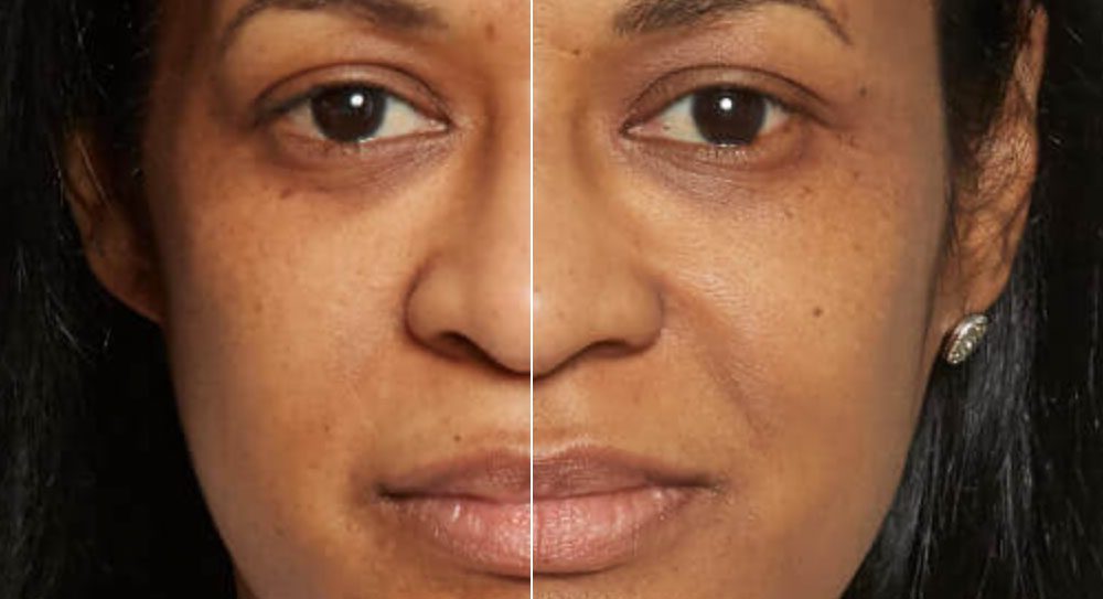 Central Ohio Aesthetics Sculptra