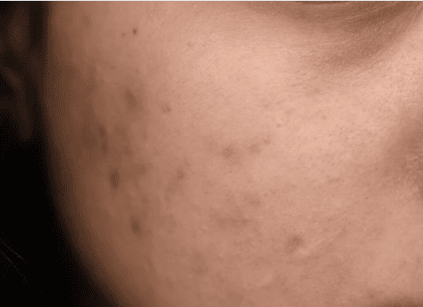 A woman with visible acne on her face, showcasing a range of skin textures and tones.