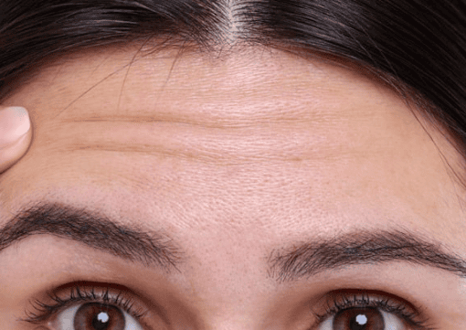 Forehead lines