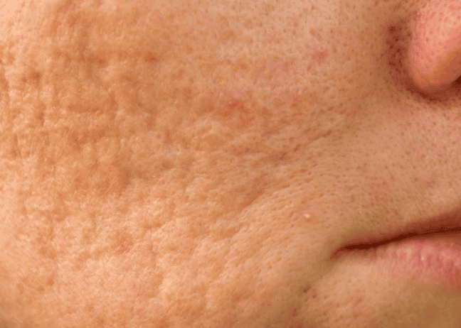 A close-up of a woman's face showing visible acne on her cheeks and forehead, highlighting skin texture and imperfections.