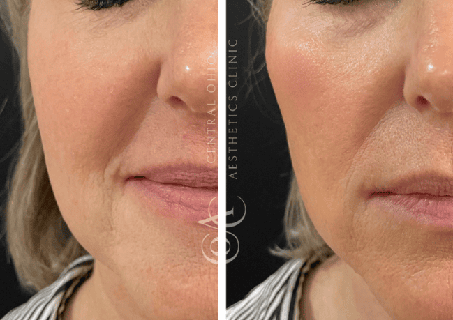 Before and after photos showing a woman's face, highlighting the effects of Botox treatment on her appearance.