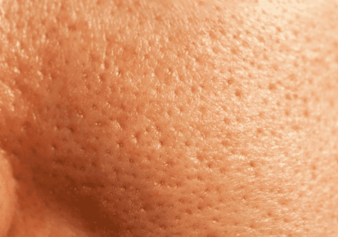 A close-up of a person's face showcasing a prominent display of freckles across their cheeks and nose.