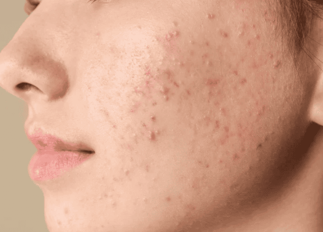 Close-up of a woman's face showing acne on her cheeks and forehead, highlighting skin texture and imperfections.