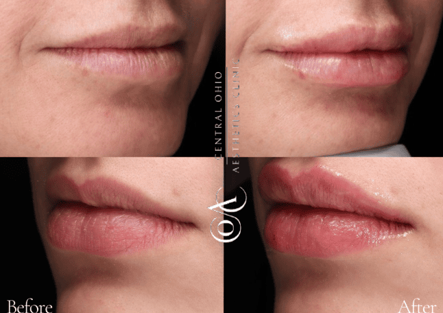 Before and after photos showcasing a woman's lips, highlighting changes in shape and fullness.