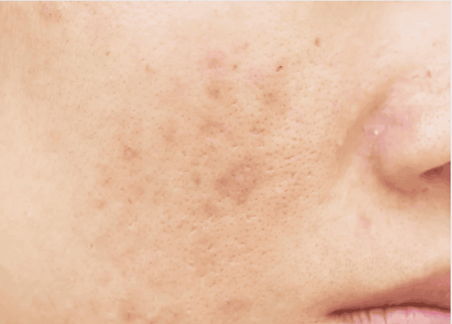A woman with visible acne on her face, looking directly at the camera with a neutral expression.