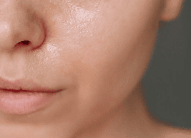 A woman with significant acne on her face, showcasing various blemishes and skin texture.