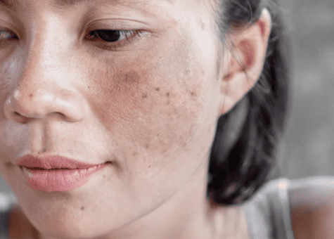 A woman with a freckled face smiles softly, showcasing her natural beauty and unique skin texture.
