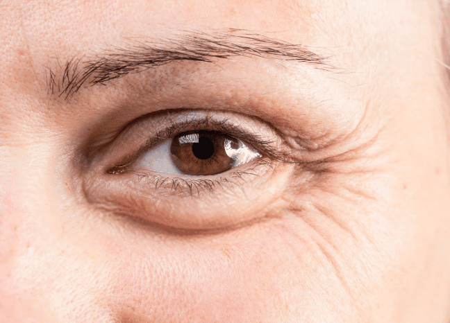 A close-up of a woman's eye showing fine wrinkles and age lines around the eyelid and brow area.