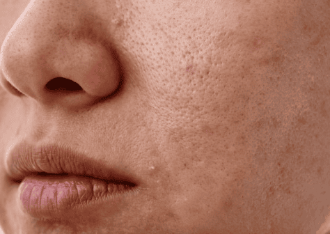 Close-up of a woman's face showing acne, highlighting skin texture and imperfections.