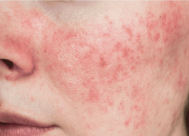 Close-up of a woman's face showing acne on her cheeks and forehead, highlighting skin texture and imperfections.