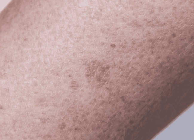 A person showing their arm with a small spot visible on the skin.