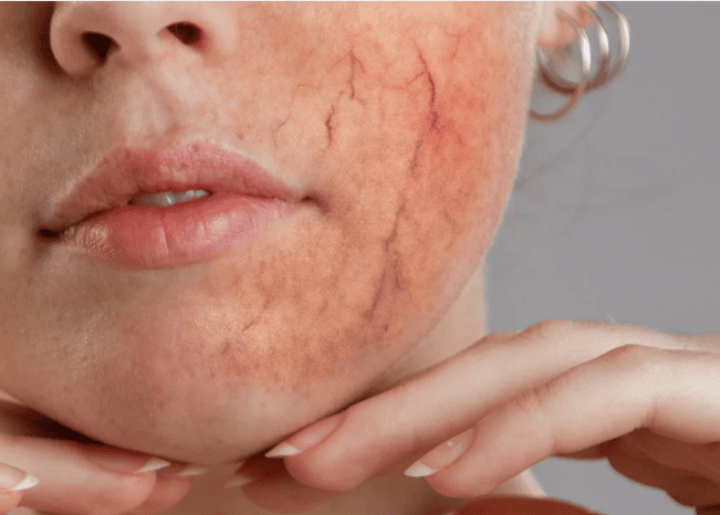 A woman with red skin on her face, displaying a unique skin condition or artistic makeup.