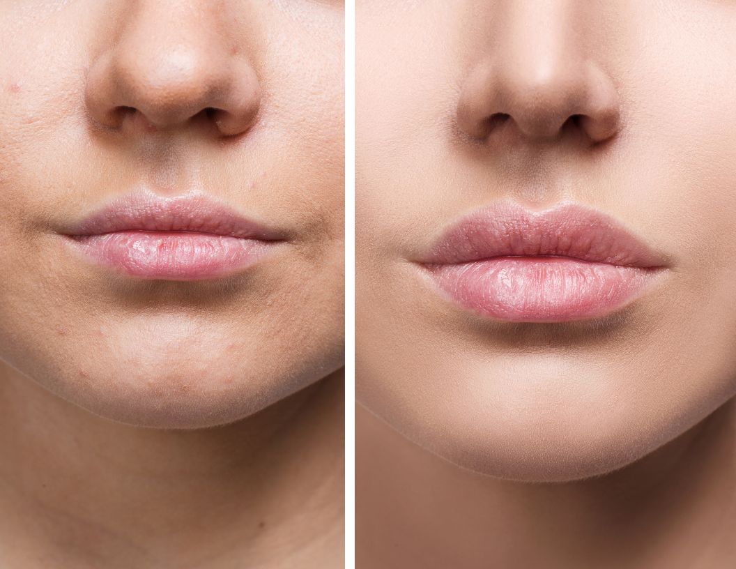 lip injections deleware ohio