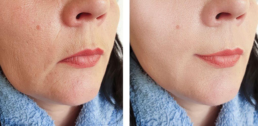 Plasma Face Filler