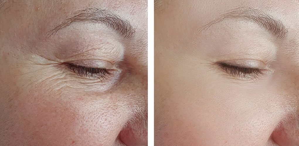 Platelet Rich Plasma Skin Treatment Central Ohio